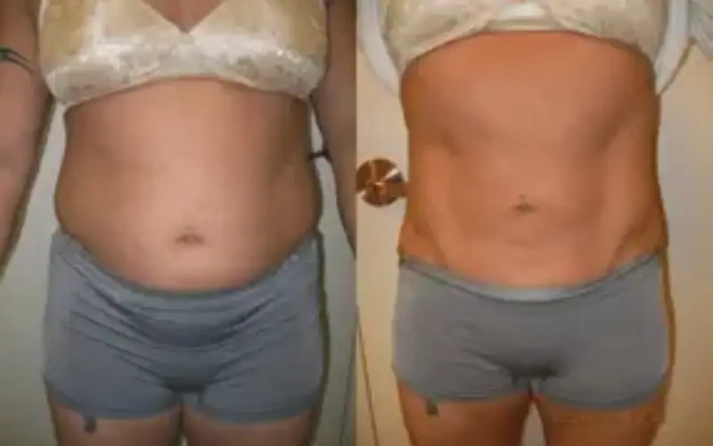 laser liposuction dc