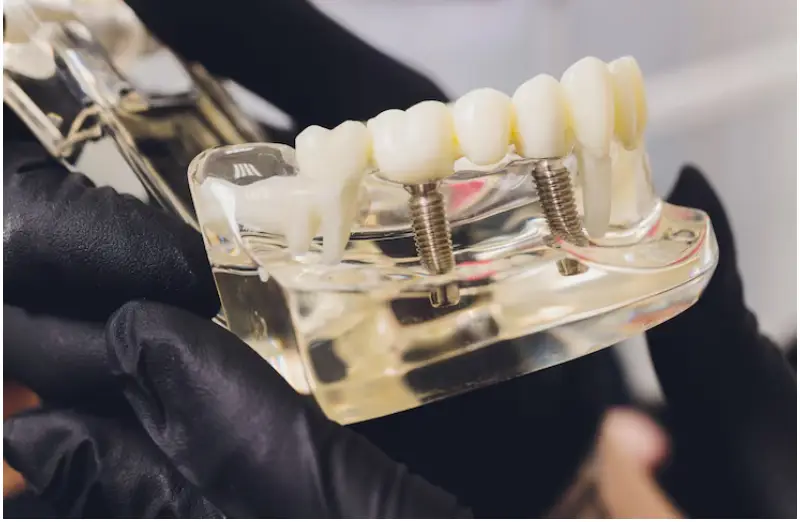All on 4 dental implants pembroke pines