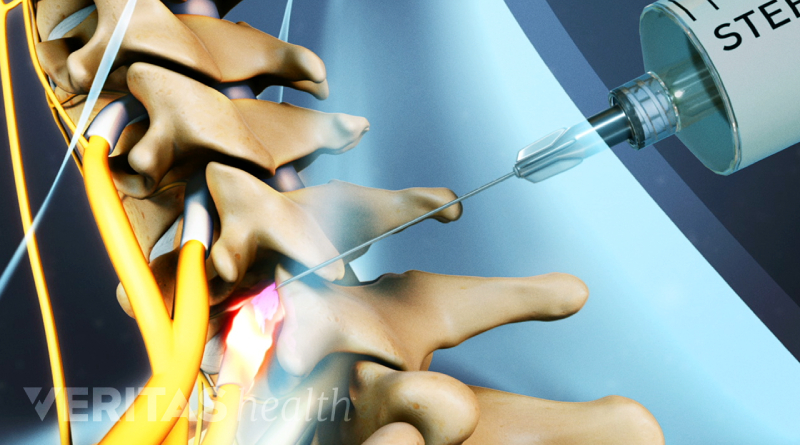 medial branch block