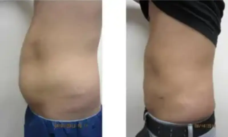 laser liposuction dc
