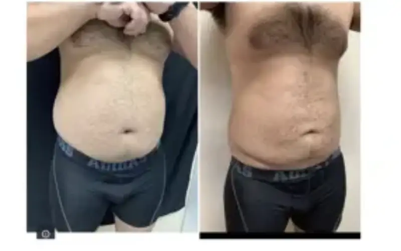 cool sculpting cost stomach