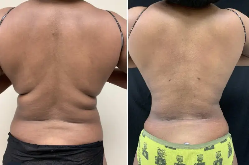 laser lipo dc