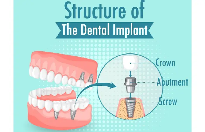all-on-x dental implants pembroke pines