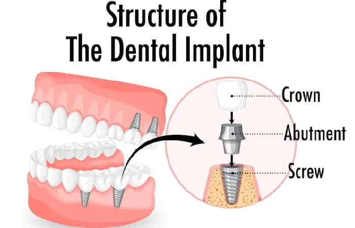 all-on-x dental implants pembroke pines